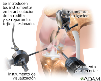 Artroscopia de rodilla - Miniatura de ilustración
              