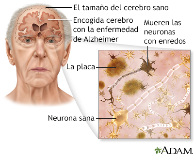 Mal de Alzheimer