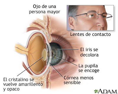 Anatomía de un ojo envejecido - Miniatura de ilustración
              