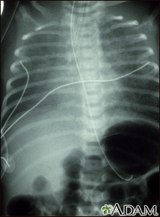 Retorno venoso pulmonar total anómalo - rayos X - Miniatura de ilustración
              