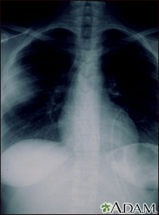 Aspergilosis - radiografía de tórax - Miniatura de ilustración
              