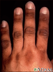 Acantosis nigricans de la mano - Miniatura de ilustración
              