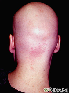 Alopecia total - vista posterior de la cabeza - Miniatura de ilustración
              