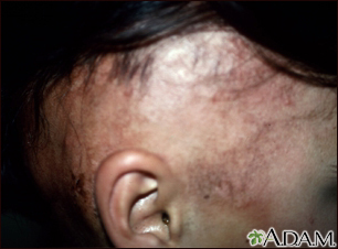 Alopecia bajo tratamiento - Miniatura de ilustración
              