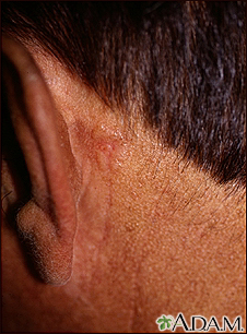 Cáncer de piel - carcinoma de célula basal detrás de la oreja - Miniatura de ilustración
              
