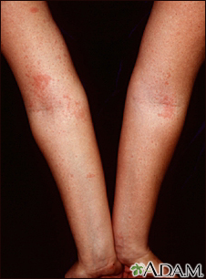 Dermatitis - atópica de los brazos