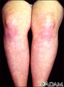 Dermatomiositis en las piernas - Miniatura de ilustración
              