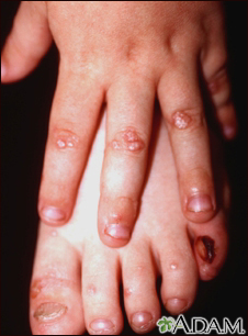 Epidermólisis bullosa, distrófica dominante