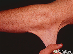 Síndrome de Ehlers-Danlos, hiperelasticidad de la piel