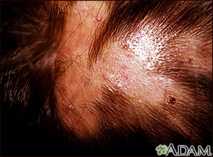 Foliculitis - descalvante en el cuero cabelludo