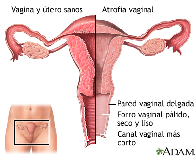 Atrofia vaginal - Miniatura de ilustración
              