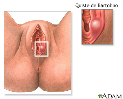 Quiste o absceso de Bartolino - Miniatura de ilustración
              