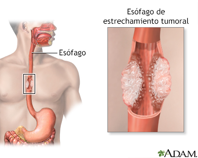 Cáncer esofágico - Miniatura de ilustración
              