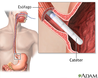 Manometría esofágica - Miniatura de ilustración
              