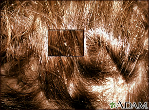 Piojos de la cabeza - primer plano de liendres en el cabello