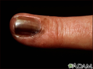 Cáncer de piel o melanoma en la uña del dedo de la mano - Miniatura de ilustración
              