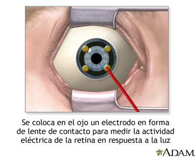 Electrodo de lente de contacto en el ojo - Miniatura de ilustración
              