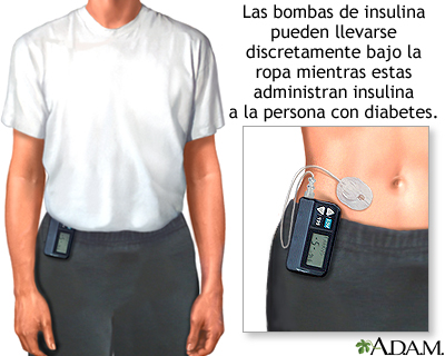 Bomba de insulina - Miniatura de ilustración
              