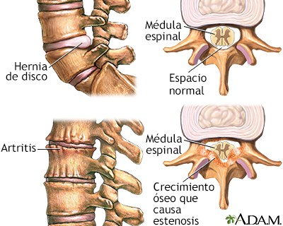 Dolor de espalda - factores de la edad - Miniatura de ilustración
              