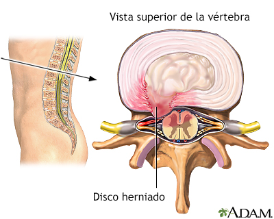 Disco herniado - Miniatura de ilustración
              