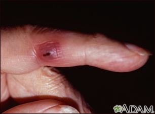Lesión de Janeway en un dedo