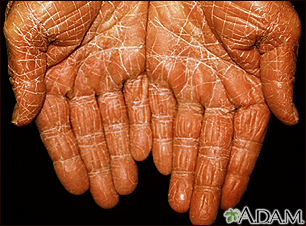 Pitiriasis rubra pilaris en las palmas de la mano