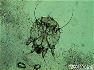 Microfotografía del ácaro de la escabiosis