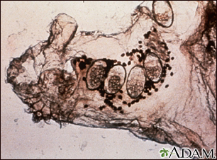 Microfotografía del ácaro de la escabiosis, los huevos y el ácaro en las heces - Miniatura de ilustración
              