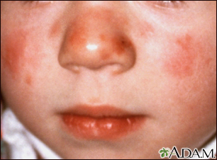 Lupus - discoide en el rostro de un niño