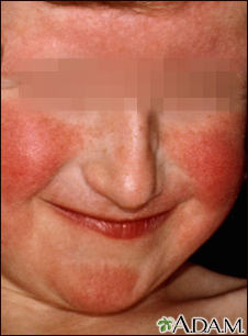 Dermatitis - atópica en la cara de una mujer joven