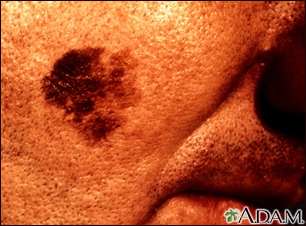 Cáncer de piel, primer plano del melanoma léntigo maligno