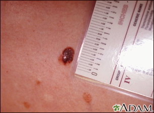 Cáncer de piel - primer plano del melanoma de nivel III - Miniatura de ilustración
              
