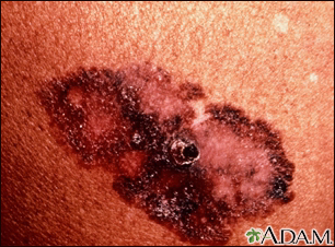 Cáncer de piel - melanoma de propagación superficial - Miniatura de ilustración
              