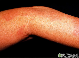 Herpes zoster (culebrilla) en el brazo