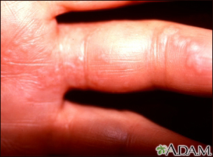 Herpes zoster (culebrilla) en la mano y dedos