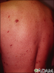Sarcoma de Kaposi en la espalda