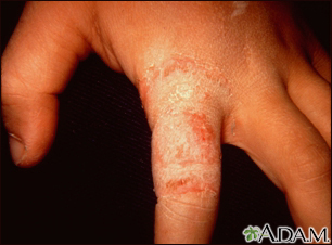 Dermatofitosis - tiña de la mano en el dedo