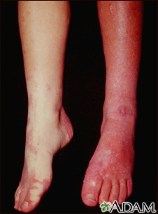 Síndrome de Sturge-Weber - piernas
