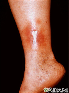 Dermatitis por estasis en la pierna