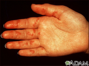Vasculitis en la palma de la mano - Miniatura de ilustración
              