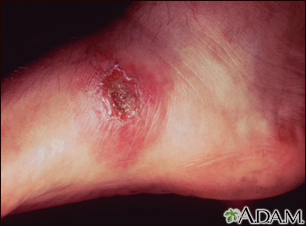 Leishmania panamensis en el pie