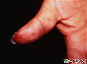 Dermatitis herpetiforme en el pulgar - Miniatura de ilustración
              