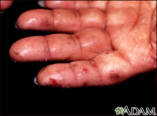 Dermatitis herpetiforme en la mano - Miniatura de ilustración
              