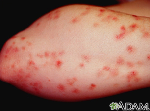 Dermatitis herpetiforme en el antebrazo