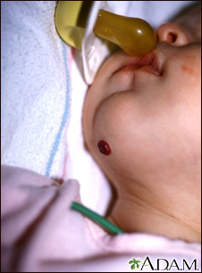 Hemangioma del mentón