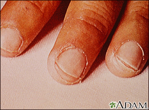 Enfermedad de Kawasaki - exfoliación de las puntas de los dedos - Miniatura de ilustración
              