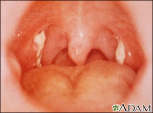 Mononucleosis - vista de la garganta