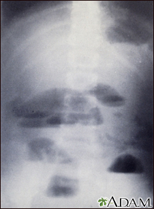 Radiografía de obstrucción del intestino delgado - Miniatura de ilustración
              
