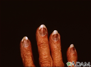 Crioglobulinemia de los dedos - Miniatura de ilustración
              