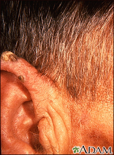 Queratosis actínica en el oído - Miniatura de ilustración
              